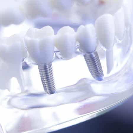 Teaser Leistungen Implantologie